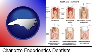 Charlotte, North Carolina - root canal treatment performed by an endodontist