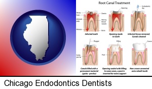 Chicago, Illinois - root canal treatment performed by an endodontist
