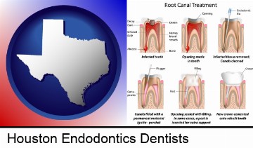 root canal treatment performed by an endodontist in Houston, TX