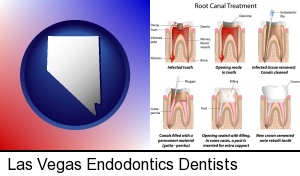 root canal treatment performed by an endodontist in Las Vegas, NV