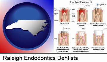 root canal treatment performed by an endodontist in Raleigh, NC