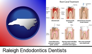 Raleigh, North Carolina - root canal treatment performed by an endodontist