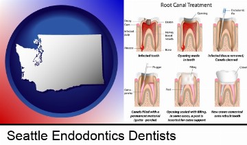 root canal treatment performed by an endodontist in Seattle, WA