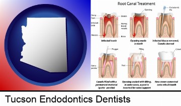 root canal treatment performed by an endodontist in Tucson, AZ