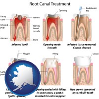 alaska map icon and root canal treatment performed by an endodontist