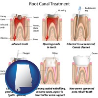 alabama map icon and root canal treatment performed by an endodontist