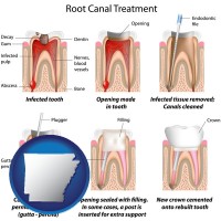 arkansas map icon and root canal treatment performed by an endodontist