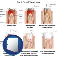 arizona root canal treatment performed by an endodontist