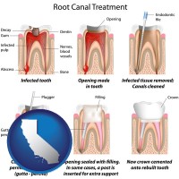 california map icon and root canal treatment performed by an endodontist