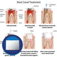 colorado map icon and root canal treatment performed by an endodontist