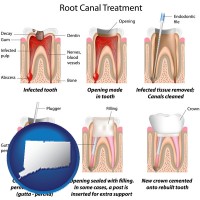 connecticut map icon and root canal treatment performed by an endodontist