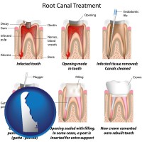 delaware map icon and root canal treatment performed by an endodontist