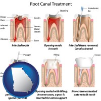 georgia map icon and root canal treatment performed by an endodontist
