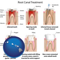 hawaii map icon and root canal treatment performed by an endodontist