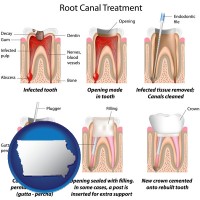 iowa map icon and root canal treatment performed by an endodontist