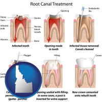 idaho map icon and root canal treatment performed by an endodontist