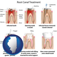 illinois map icon and root canal treatment performed by an endodontist