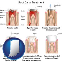 indiana map icon and root canal treatment performed by an endodontist