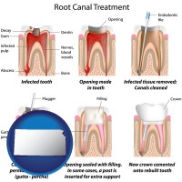 kansas map icon and root canal treatment performed by an endodontist