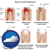 kentucky map icon and root canal treatment performed by an endodontist