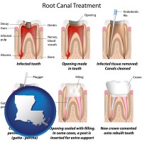 louisiana map icon and root canal treatment performed by an endodontist