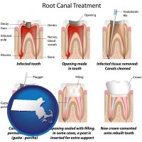 massachusetts map icon and root canal treatment performed by an endodontist