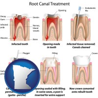 minnesota map icon and root canal treatment performed by an endodontist