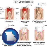 missouri map icon and root canal treatment performed by an endodontist