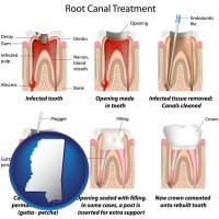mississippi map icon and root canal treatment performed by an endodontist