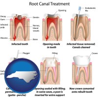north-carolina map icon and root canal treatment performed by an endodontist