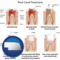 nebraska map icon and root canal treatment performed by an endodontist