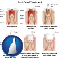 new-hampshire map icon and root canal treatment performed by an endodontist