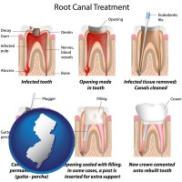 new-jersey map icon and root canal treatment performed by an endodontist