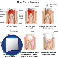 new-mexico map icon and root canal treatment performed by an endodontist