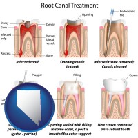 nevada map icon and root canal treatment performed by an endodontist