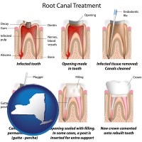 new-york map icon and root canal treatment performed by an endodontist