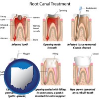 ohio map icon and root canal treatment performed by an endodontist