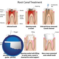 oklahoma map icon and root canal treatment performed by an endodontist