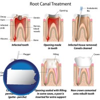 pennsylvania map icon and root canal treatment performed by an endodontist