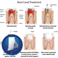 rhode-island map icon and root canal treatment performed by an endodontist