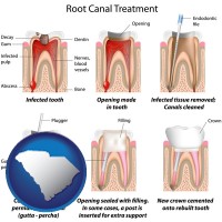 south-carolina map icon and root canal treatment performed by an endodontist