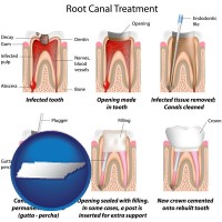 tennessee map icon and root canal treatment performed by an endodontist