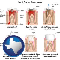 texas map icon and root canal treatment performed by an endodontist
