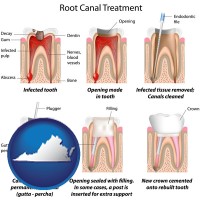 virginia map icon and root canal treatment performed by an endodontist
