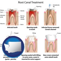 washington map icon and root canal treatment performed by an endodontist