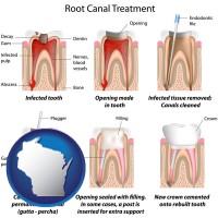 wisconsin map icon and root canal treatment performed by an endodontist