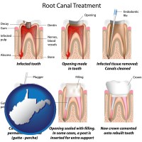 west-virginia map icon and root canal treatment performed by an endodontist