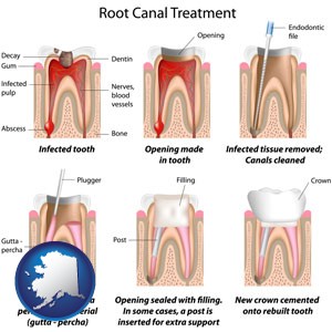 root canal treatment performed by an endodontist - with Alaska icon