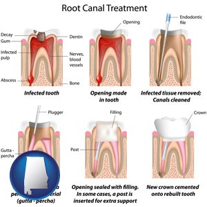 root canal treatment performed by an endodontist - with Alabama icon