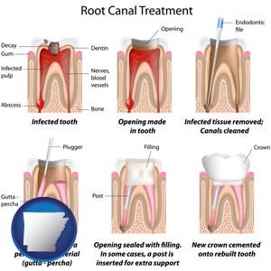 root canal treatment performed by an endodontist - with Arkansas icon